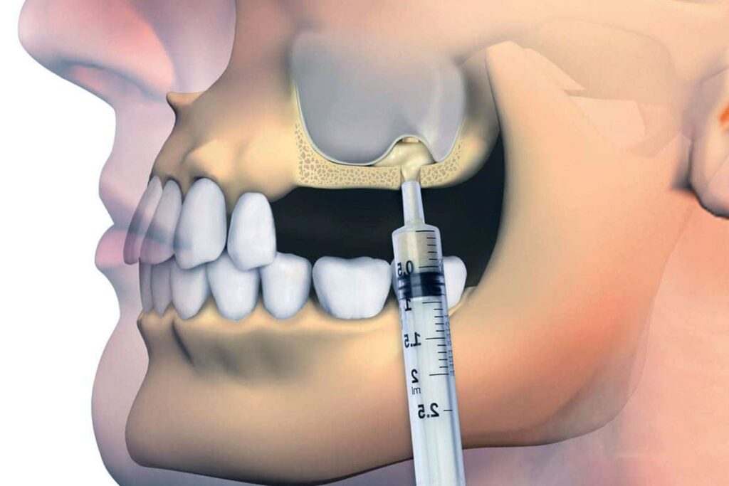 Az arcüreg és a felső őrlőfogak helyzete, sinus lift szemléltető ábra
