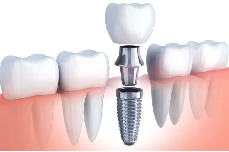 Fogimplantátum felépítése: implantátum, felépítmény és korona