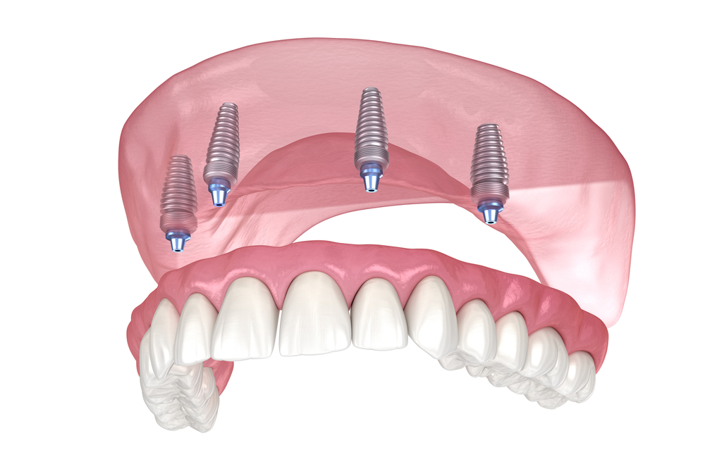 Szemléltető ábra: teljes fogsor négy implantátumon rögzítve