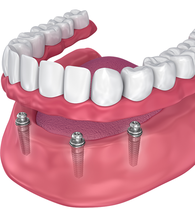 Fogsor implantátumokon